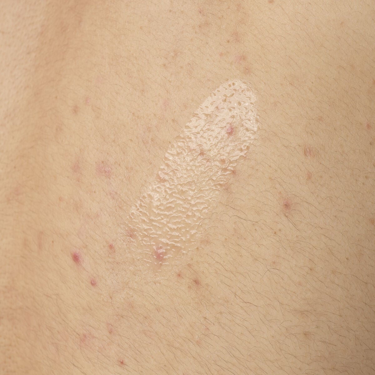 salicylic-acid-0-5-body-serum-d2 ORD-salicylic-acid-05-body-240ml-application.jpg