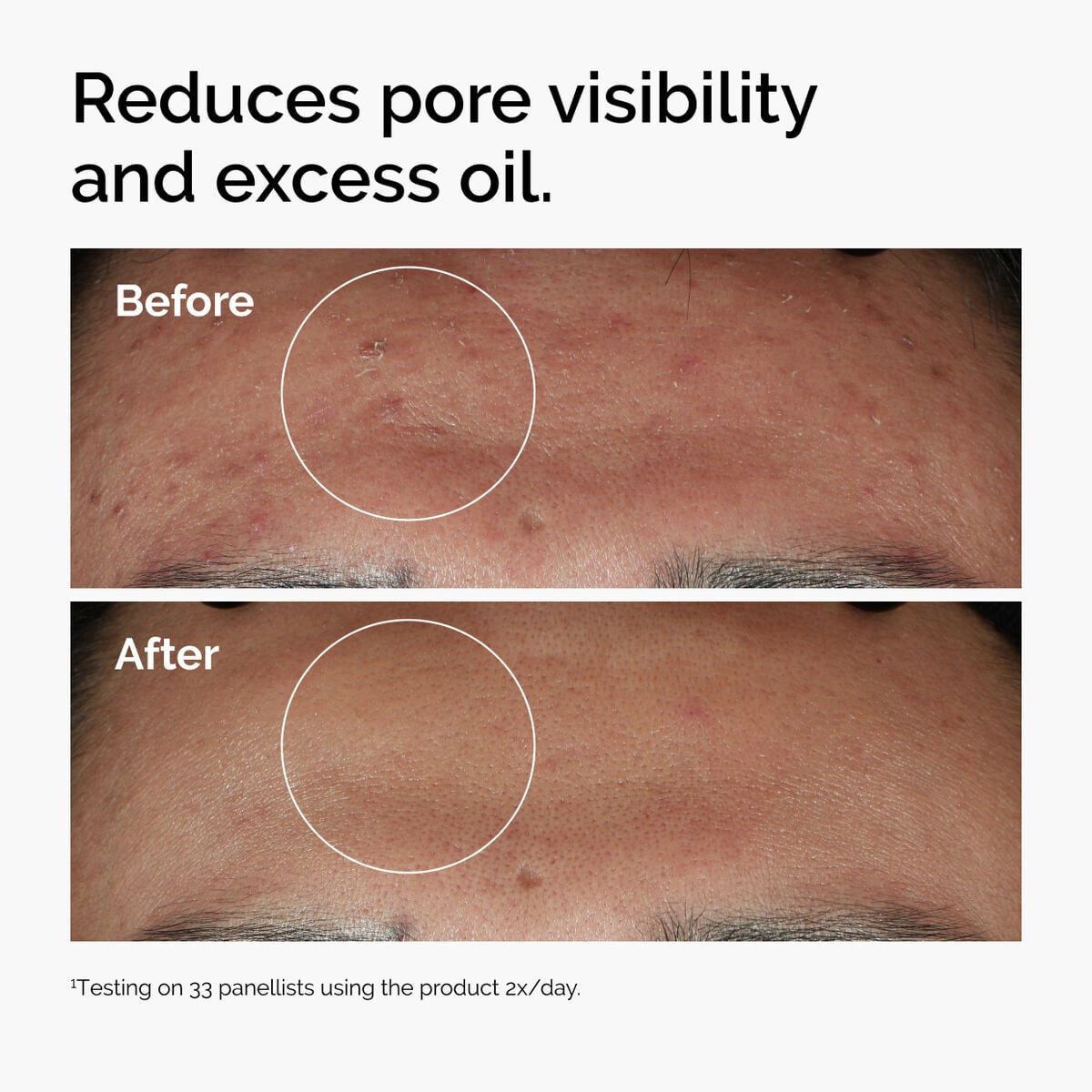 niacinamide-10-zinc-1-o3 ord-niacinamide-zinc-blemish-serum-before-after-pores.jpg