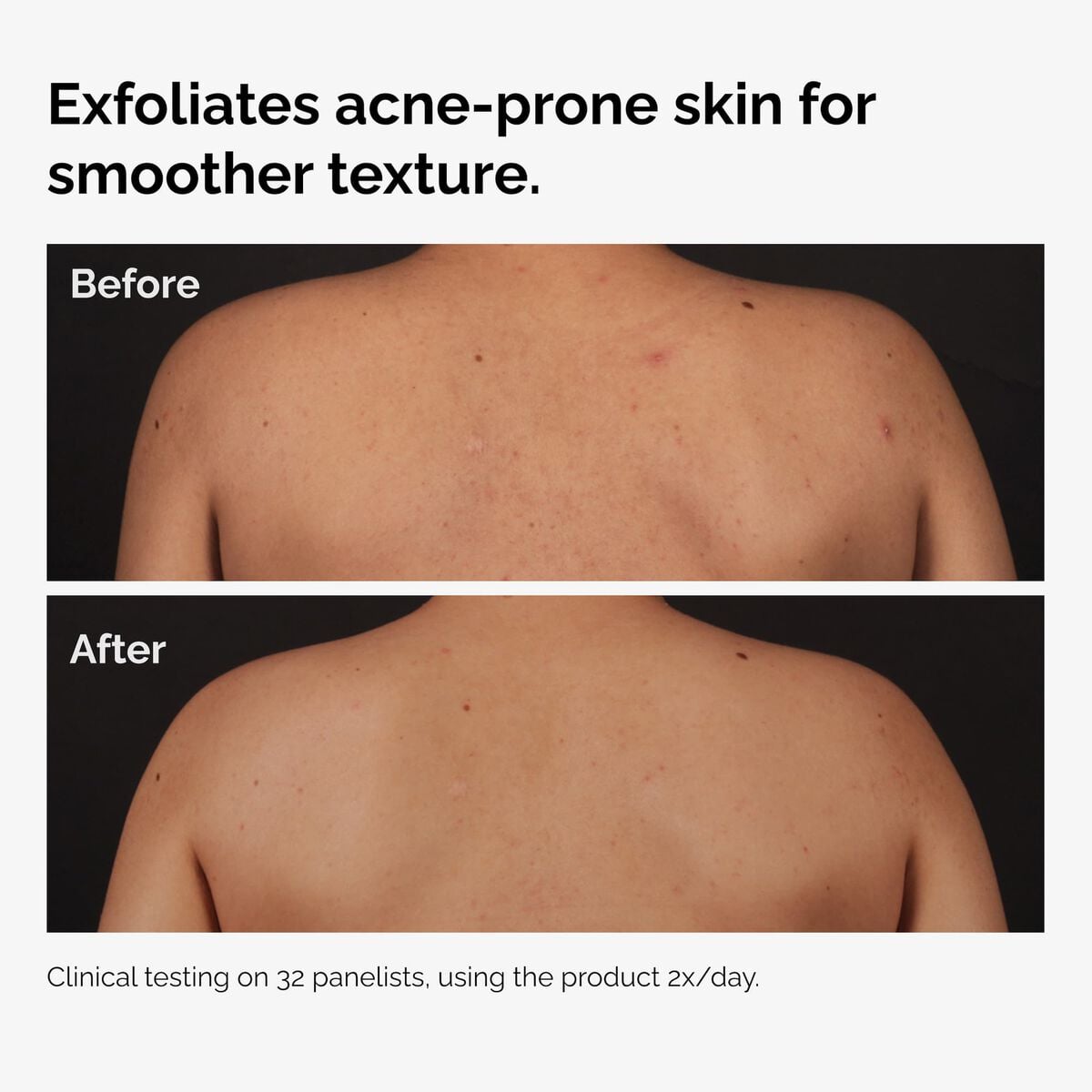 salicylic-acid-0-5-body-serum-d2 ord-salicylic-acid-body-serum-before-after-graphic-NA.jpg