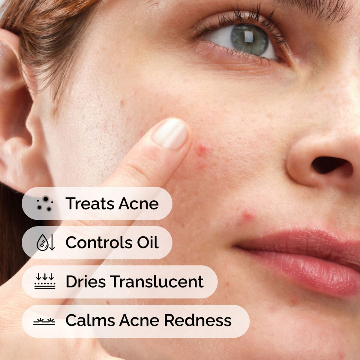 sulfur-10-powder-to-cream-concentrate-g9 ord-sulfur-10pct-powder-to-cream-concentrate-model-application-with-benefits-acne.jpg