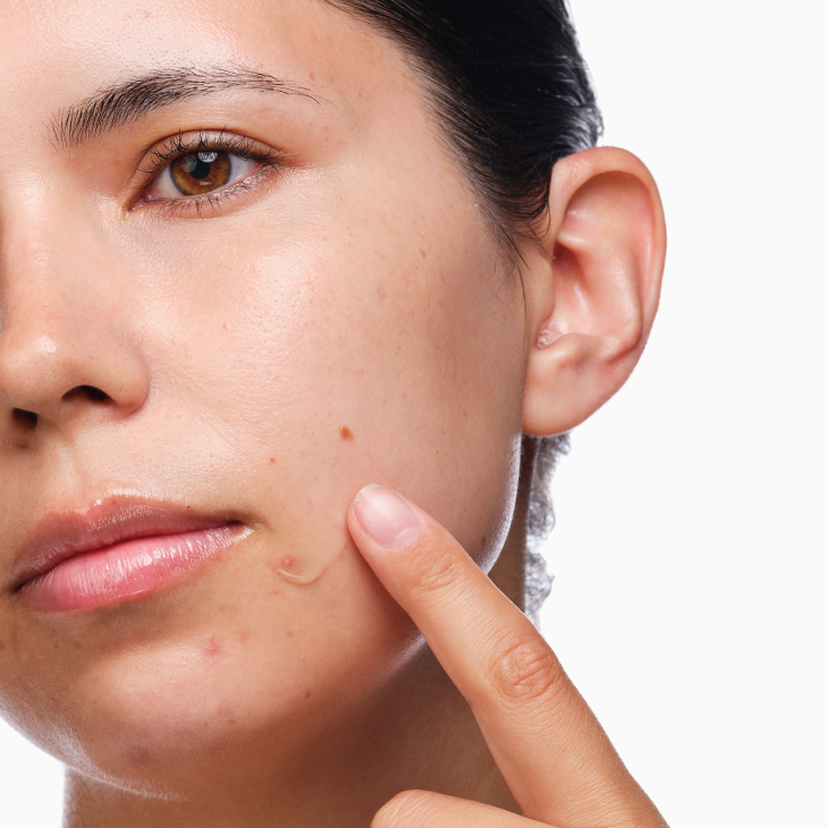 the-acne-set-p9 rdn-the-acne-set-application.png